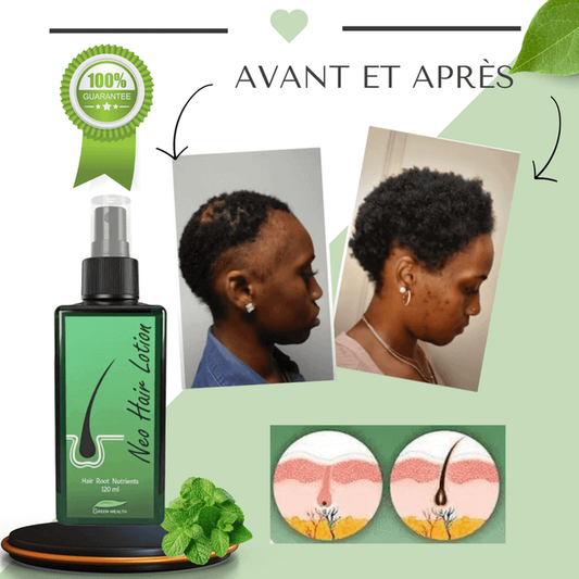 Dites Adieu Aux Cheveux Clairsemés Et Aux Plaques Chauves